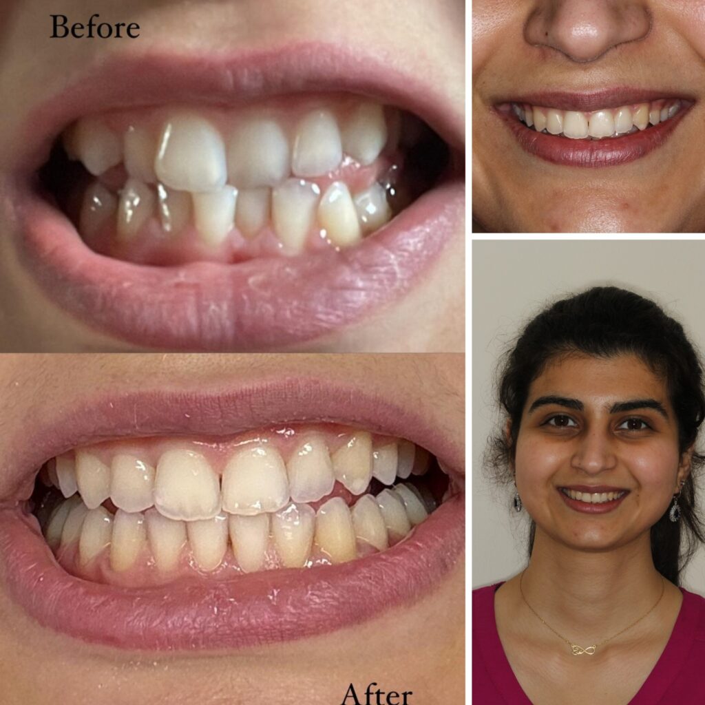 Six Month Smiles Transformation