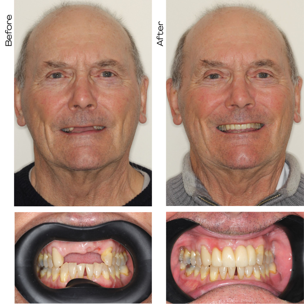 Dental implant in guildford