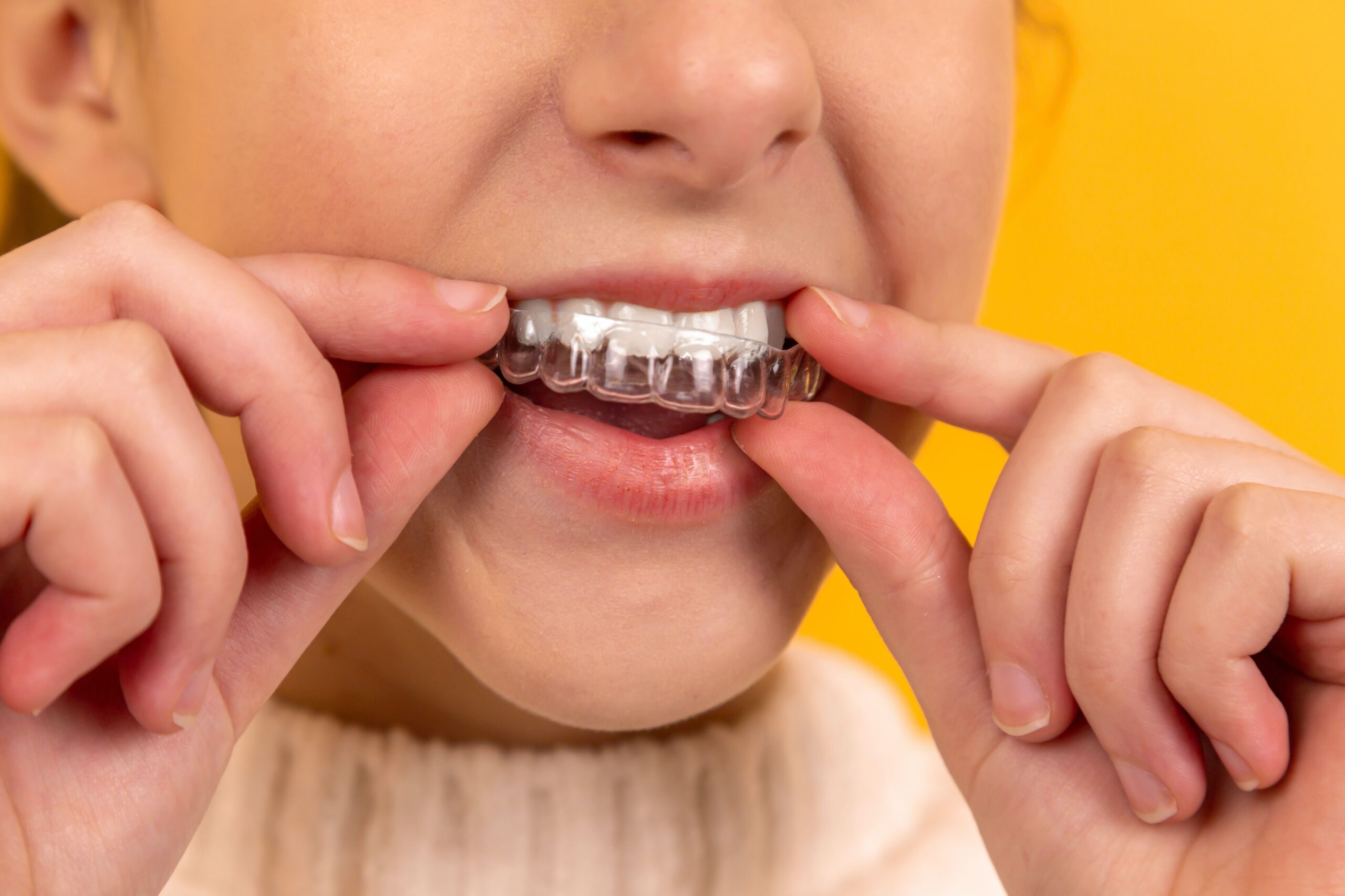 Clear braces and Invisalign consultation at Woodbridge Hill Dental Practice