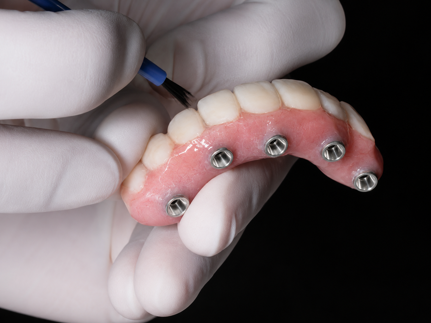 Full-mouth dental implant treatment in Guildford