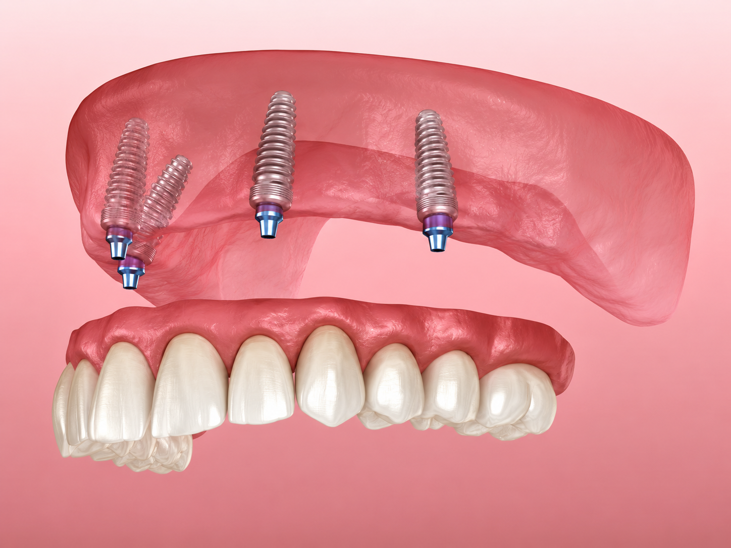 All on 4 dental implants in Guildford