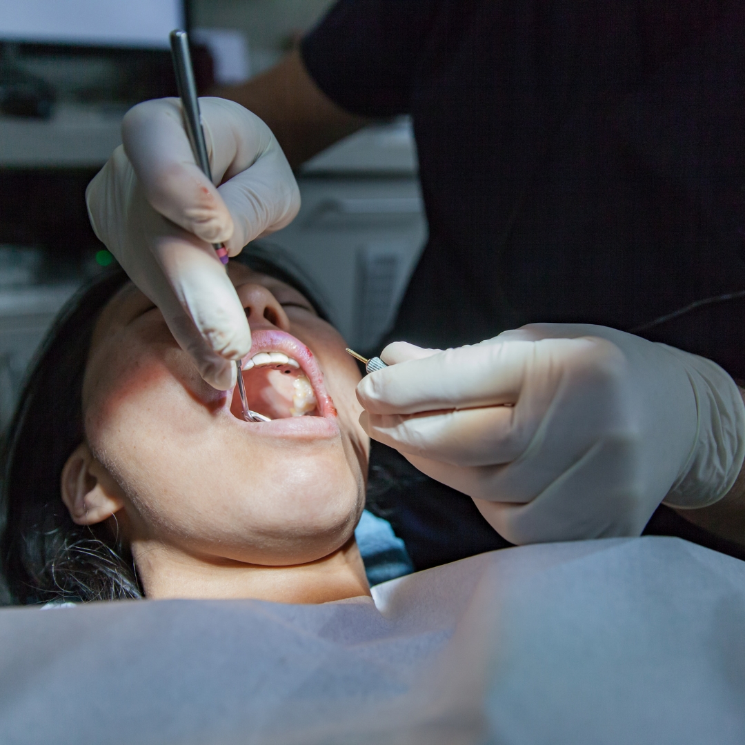 Complex Dental Extractions in Guildford