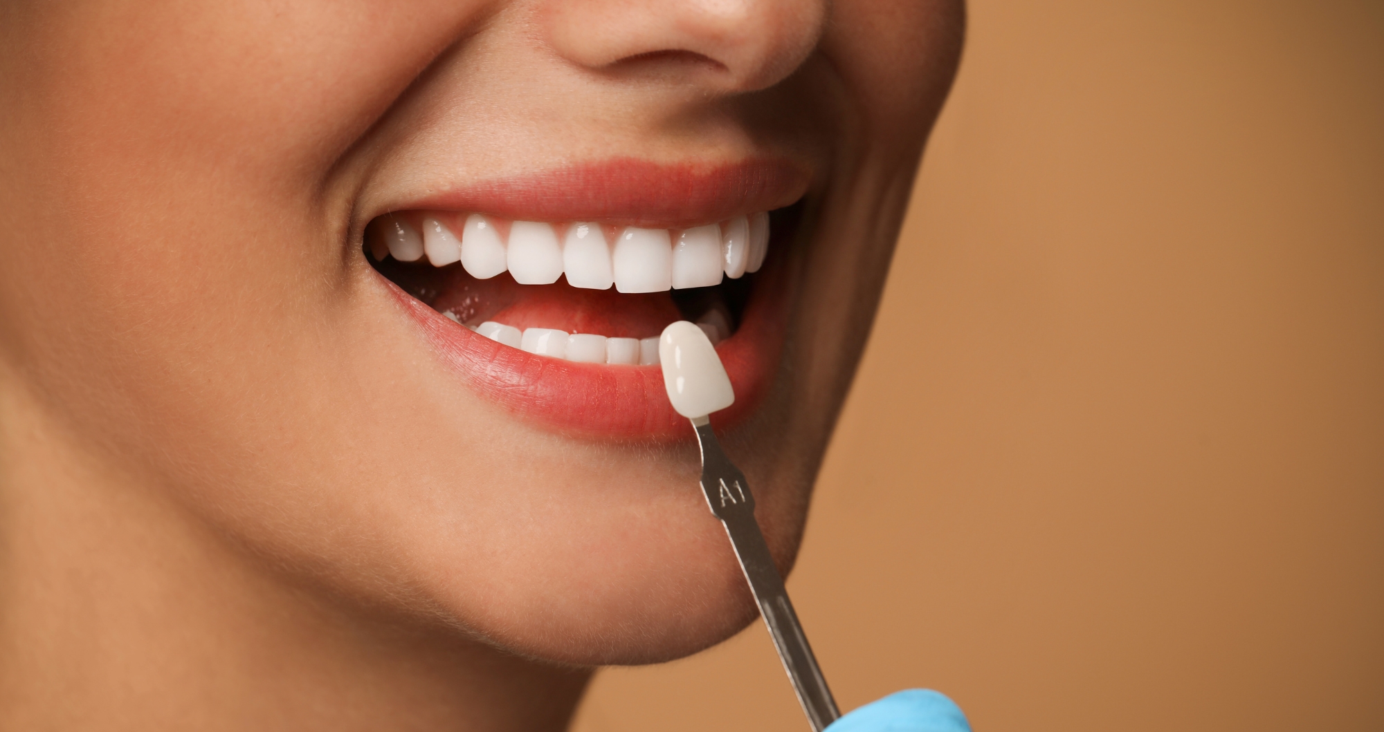 Woodbridge Hill Dental Practice porcelain veneer specialist in Guildford Surrey