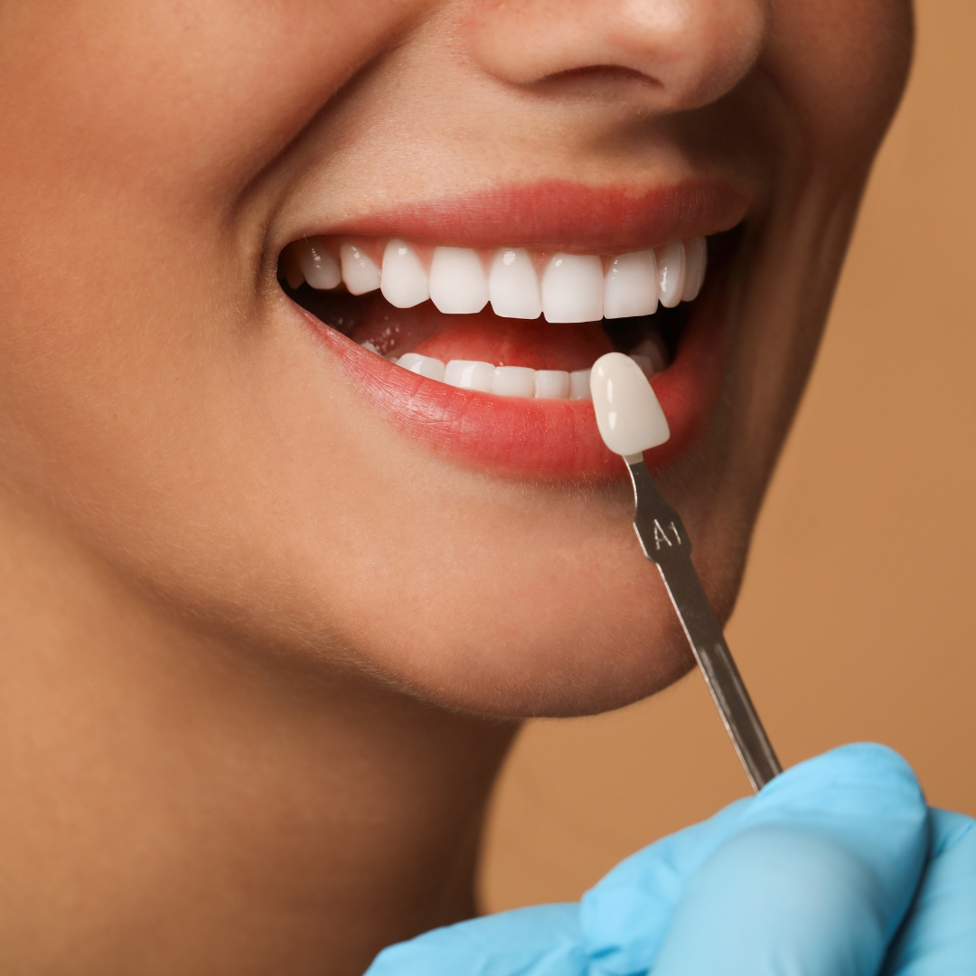 Veneer consultation at Woodbridge Hill Dental Practice Guildford