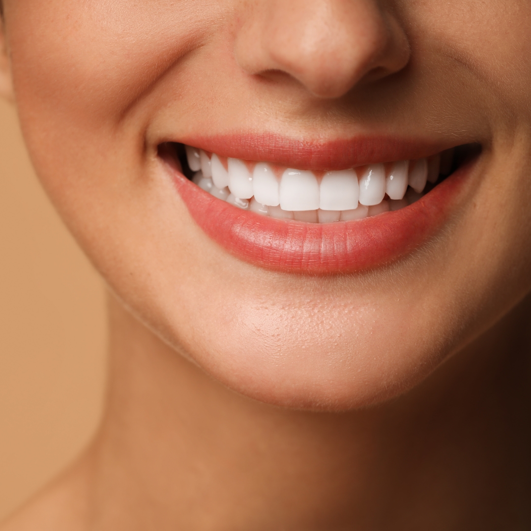 Natural-looking porcelain veneers in Guildford Surrey