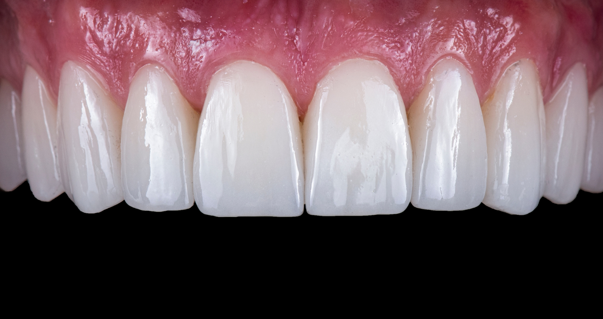 Porcelain veneers improving smile shape and colour in Guildford