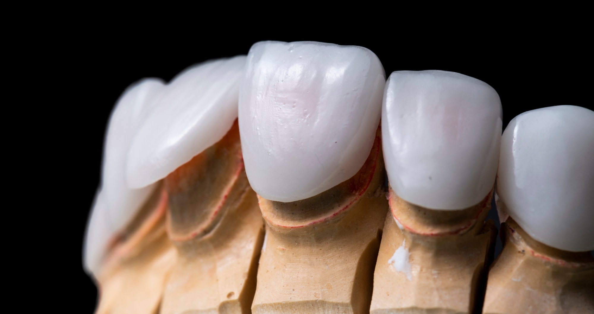 Porcelain veneers consultation in Guildford