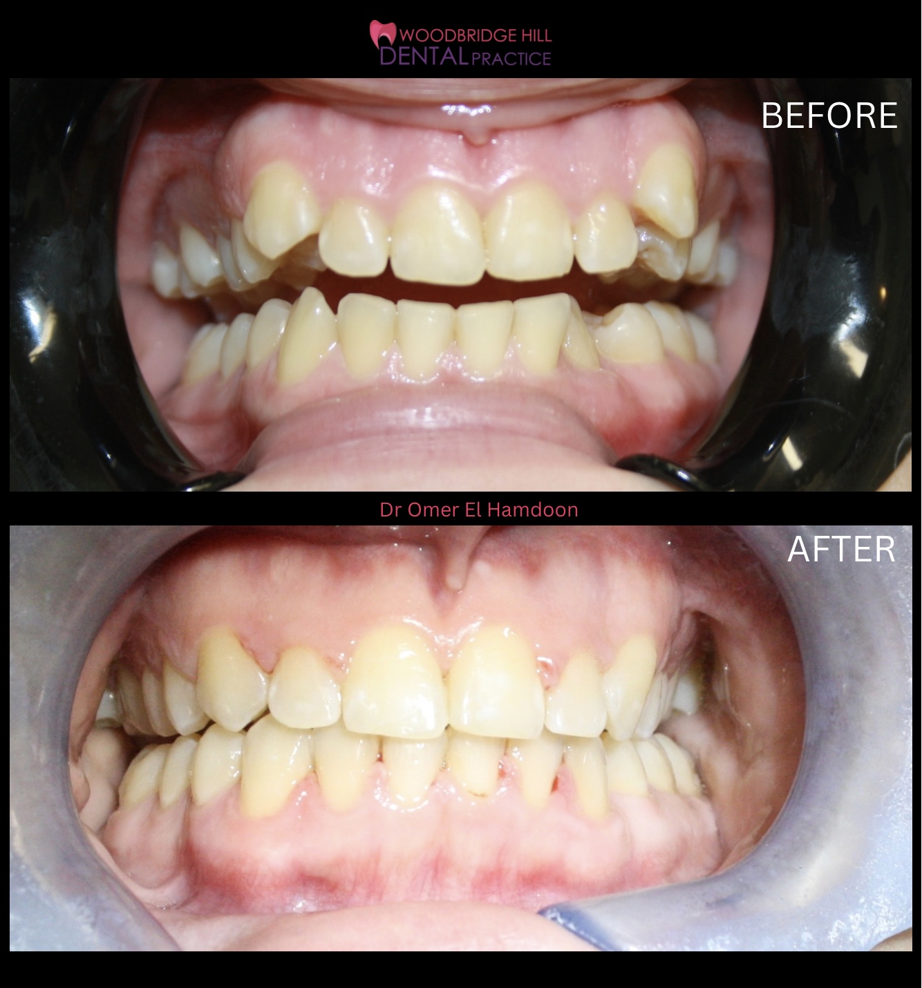 Orthodontic smile transformation case