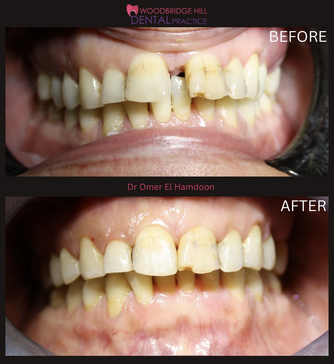 Orthodontic smile transformation case
