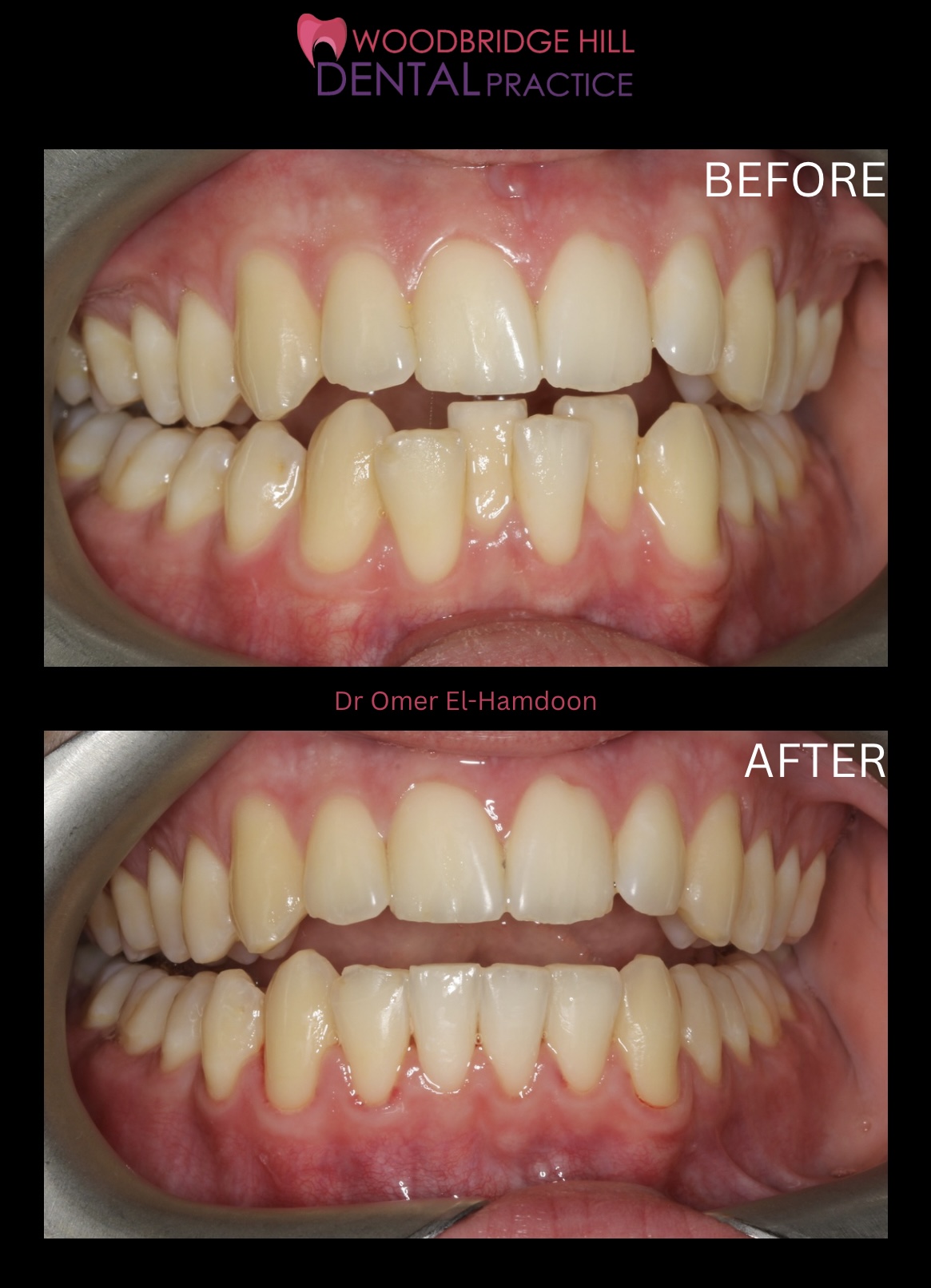 Orthodontic smile transformation case
