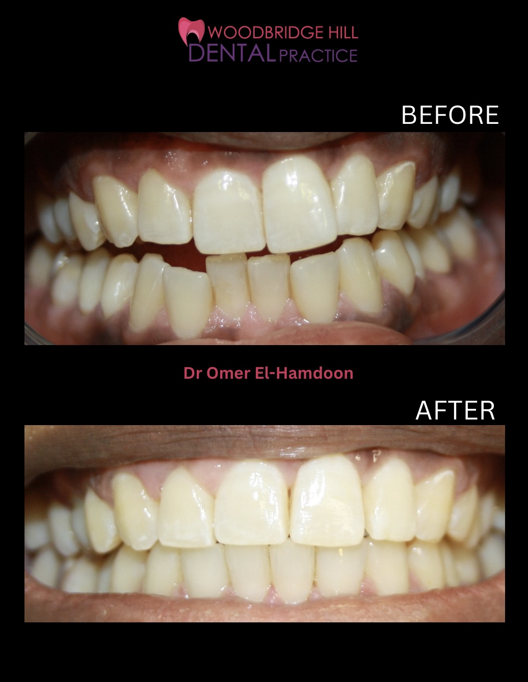Orthodontic smile transformation case